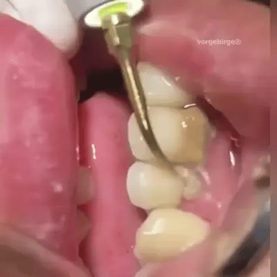 Limpieza Dental Ultrasónica Portátil